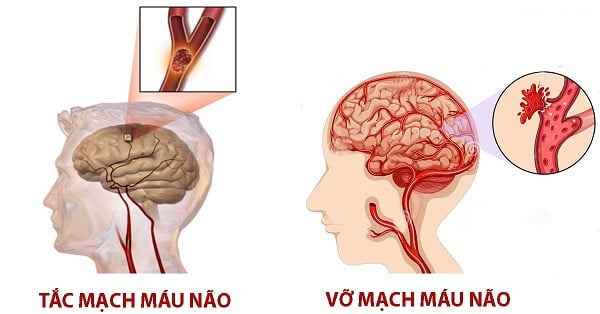 thời gian người bị tai biến sống được bao lâu