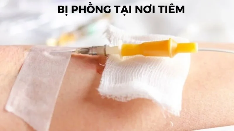 Cách xử lý tai biến khi tiêm tĩnh mạch? 9 Bị phồng nơi tiêm tĩnh mạch