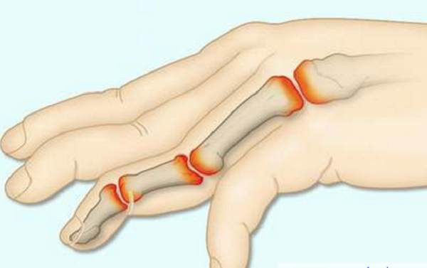 Cách giảm đau nhức khớp xương tay