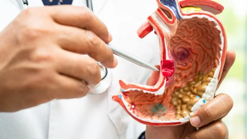 Ăn nhiều dầu ăn có tốt không? Có gây hại gì không? 25 Dầu ăn có thể gây nguy cơ ung thư hệ tiêu hóa