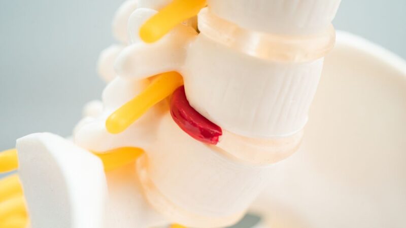 Ngủ dậy bị đau lưng, Nguyên nhân và cách khắc phục 25 Ngủ dậy bị đau lưng là triệu chứng của đau cơ xơ hoá