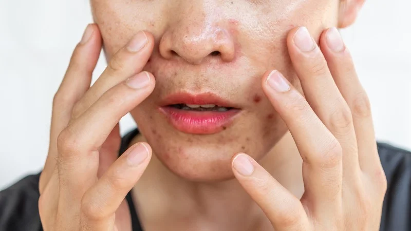 Bôi dầu oliu lên mặt qua đêm có tốt không? 21 Gây tăng tiết dầu trên da