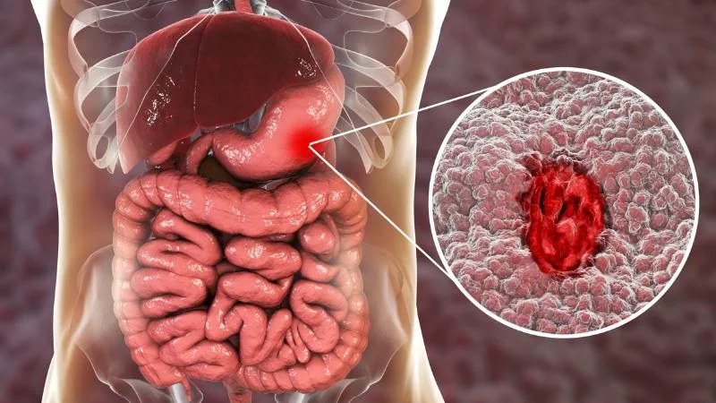 Tác Hại Của Dầu Oliu Với Sức Khỏe: Những Điều Ít Ai Nói Ra 26 Dầu oliu gây viêm trong một số trường hợp trong cơ thể