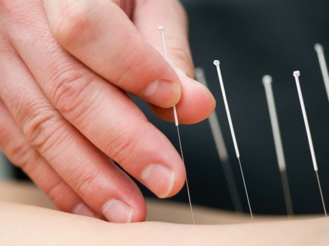 Người bị tai biến nhẹ nên LÀM GÌ để phục hồi chức năng? 8 Điều trị tai biến bằng cách châm cứu