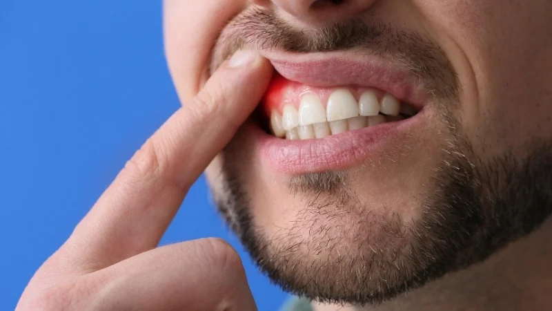Ngậm dầu mè có tác dụng gì? Có tốt hay không? 22 Ngậm dầu mè giúp làm dịu vết thương trong miệng