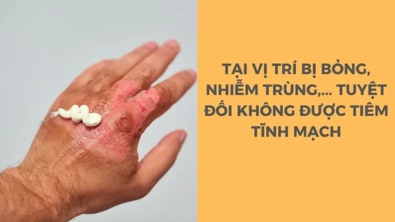 Cách xử lý tai biến khi tiêm tĩnh mạch? 8 Vị trí bị bỏng, vết thương hở bị nhiễm trùng tuyệt đối không được tiêm tĩnh mạch