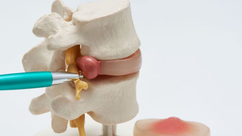 15 nguyên nhân gây đau lưng có thể bạn chưa biết 22 Thoát vị đĩa đệm gây đau lưng