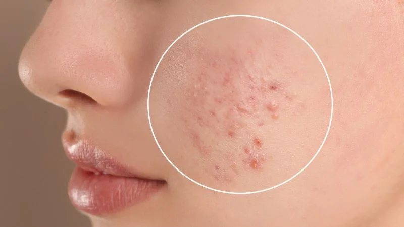 Massage mặt hàng ngày có tốt không? Có tác hại gì không? 12 Không nên massage trực tiệp lên phần da bị nổi mụn