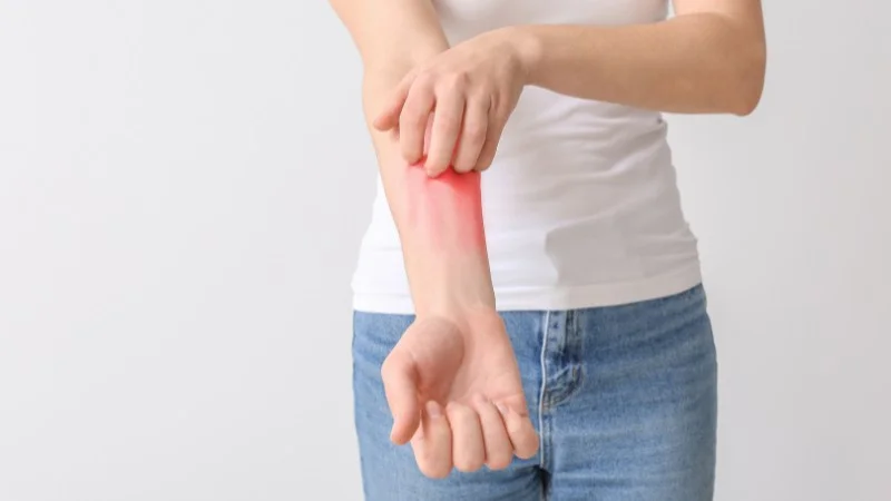 Dầu hạt điều: Lợi ích, tác hại và cách sử dụng 29 Gây dị ứng