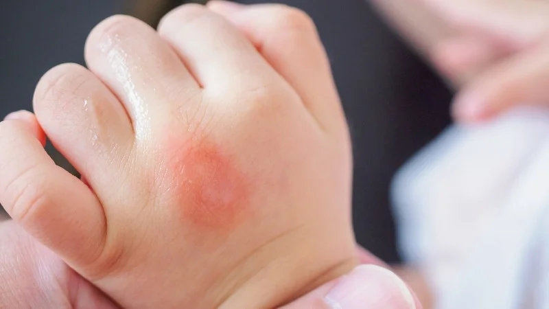 Lợi ích khi dùng dầu macca cho bé ăn dặm 17 Giúp vết thương mau lành