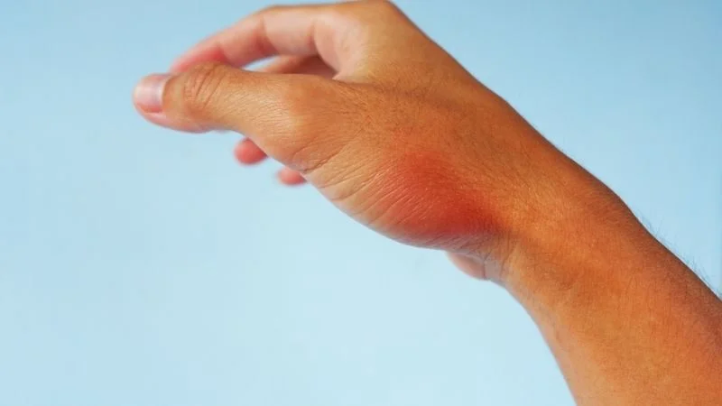 Cách trị rết cắn tại nhà hiệu quả trong trường hợp khẩn cấp 9 Hậu quả khi bị rết cắn