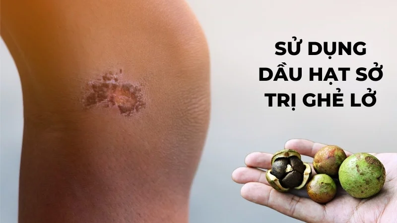 Tiết lộ 10 ứng dụng rộng rãi của dầu sở trong đời sống 22 Sử dụng dầu hạt sở chữa ghẻ lở
