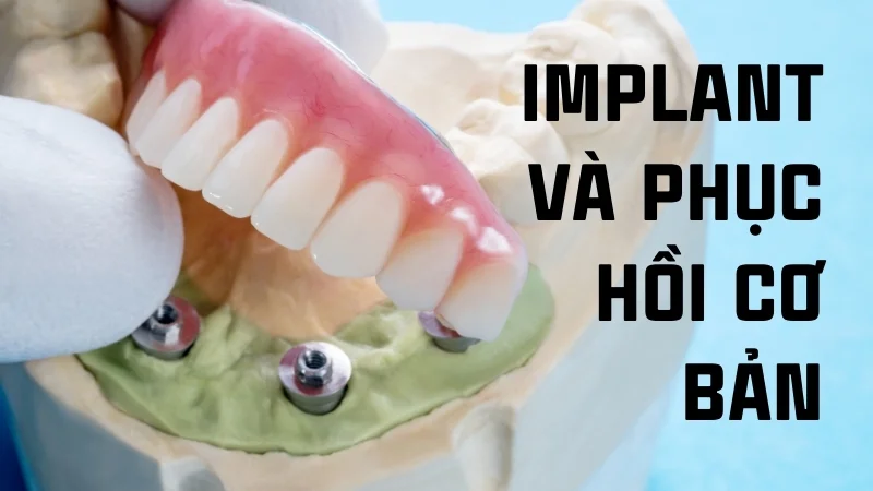 Ứng dụng của nhôm trong đời sống, công nghiệp, y tế 35 Nhôm trong implant và phục hồi cơ bản